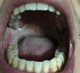 吃伽师瓜口腔刺痛,揭秘美味背后的隐患